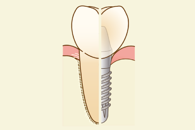 インプラントと天然歯の違い、骨とインプラントは接合していても、歯ぐきを繋ぐことはできません。