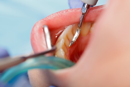 適切な予防措置を施しながら、必要以上に歯を削らない、なおかつ虫歯を取り残さない、という考え