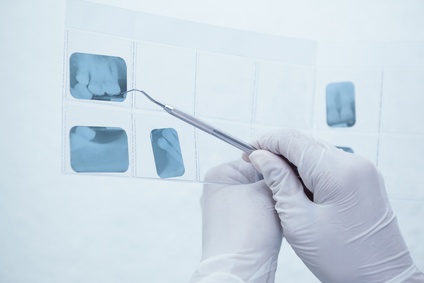 虫歯や根尖病変など診断に必要な「デンタルレントゲン写真」を撮ります。