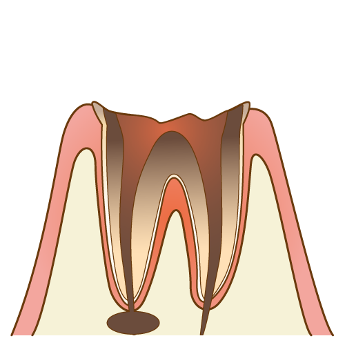 ⊕拡大：C4の歯の断面図