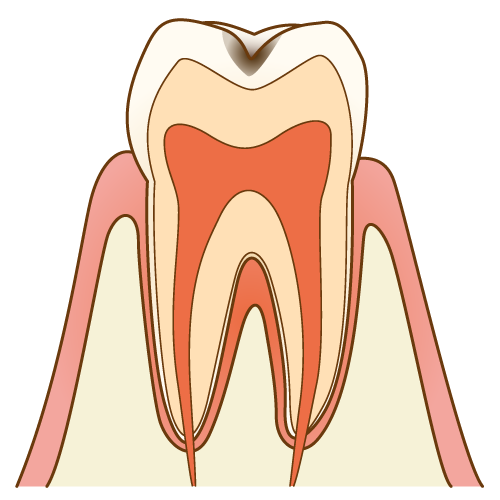 ⊕拡大：C1の歯の断面図